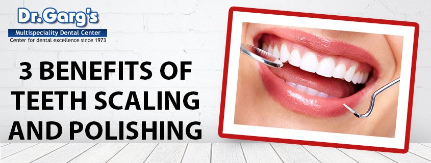 teeth scaling and polishing