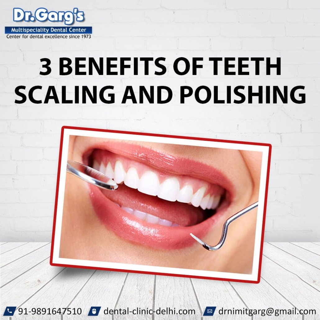 Teeth Scaling and Polishing 1030x1030 - 3 Benefits of Teeth Scaling and Polishing