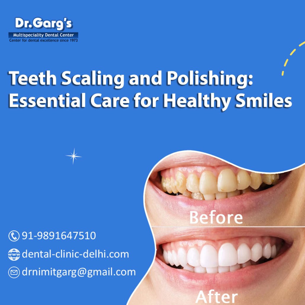 teeth scaling and polishing essential care for healthy smiles 1030x1030 - Teeth Scaling and Polishing: Essential Care for Healthy Smiles