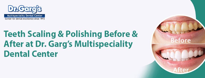 teeth-scaling-and-polishing-before-and-after-at-dr.. DentalScalingAndPolishing