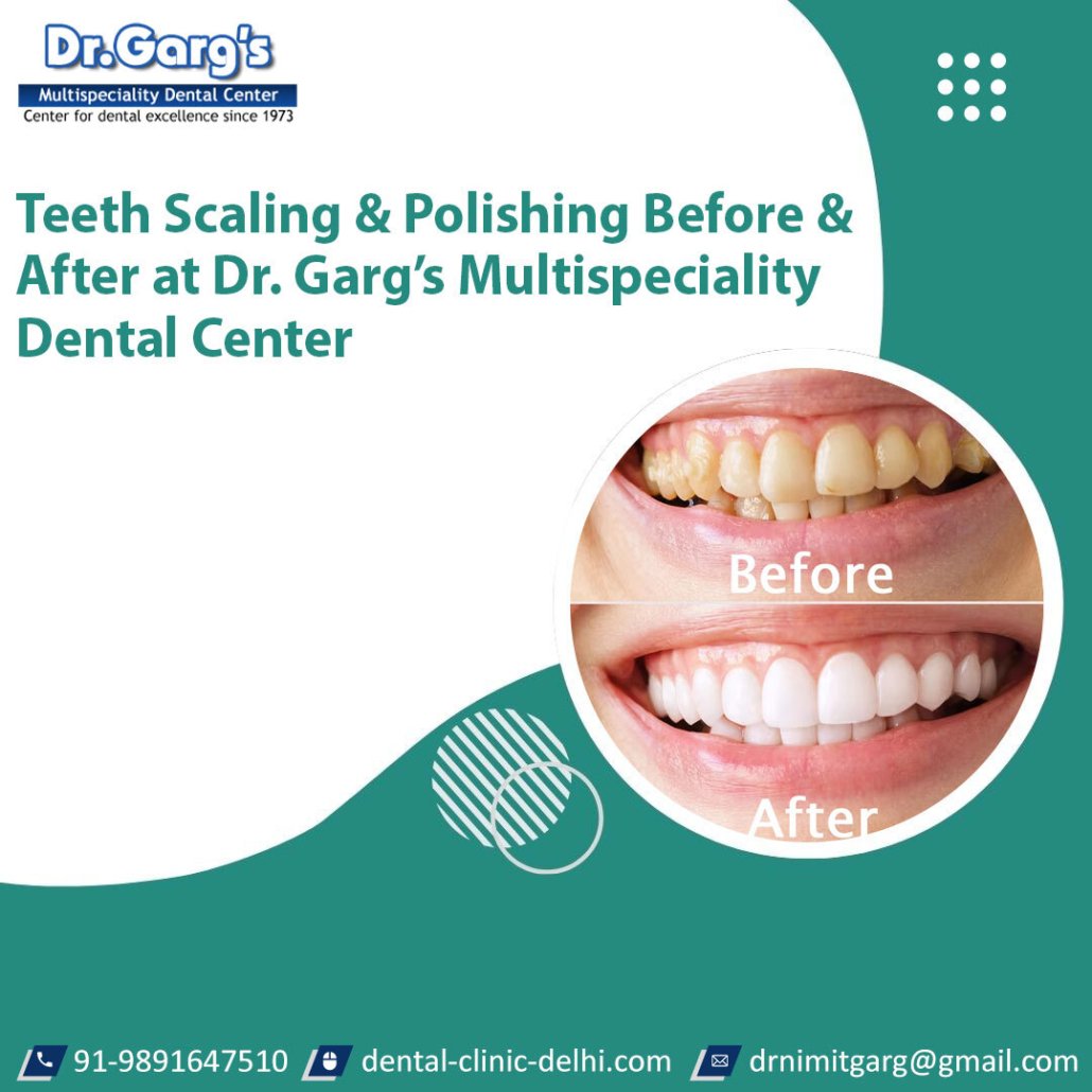 Teeth Scaling and Polishing Before and After at Dr. Garg’s Multispeciality Dental Center teeth scaling and polishing before and after at dr 1030x1030 - Teeth Scaling and Polishing Before and After at Dr. Garg’s Multispeciality Dental Center