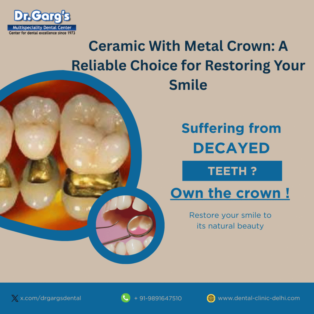 Ceramic With Metal Crown A Reliable Choice for Restoring Your Smile 1030x1030 - Ceramic With Metal Crown: A Reliable Choice for Restoring Your Smile