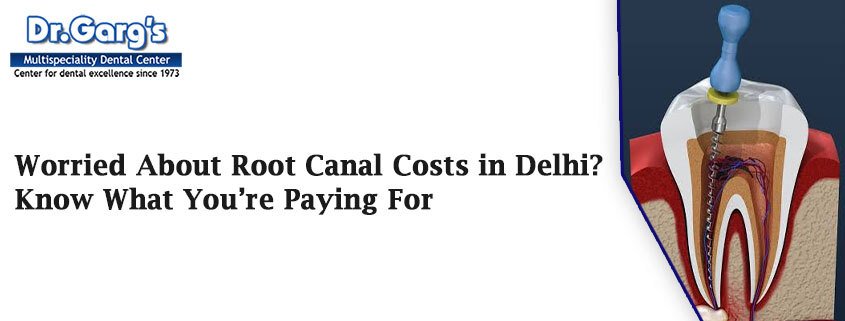 Worried About Root Canal Costs in Delhi? Know What You’re Paying For Feature Image 4 - Worried About Root Canal Costs in Delhi? Know What You’re Paying For
